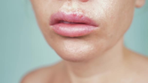 Herpes en los labios femeninos. 4k, primer plano, fondo azul, desenfoque, cámara lenta — Vídeos de Stock