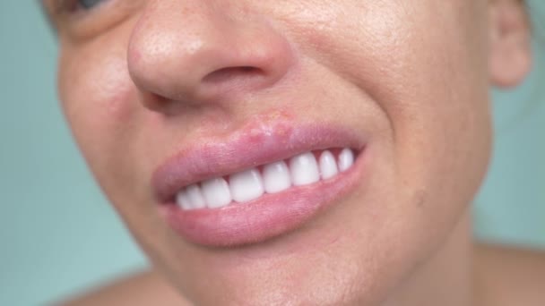 Herpes op de vrouwelijke lippen. 4k, close-up, blauwe achtergrond, vervagen, slow-motion — Stockvideo