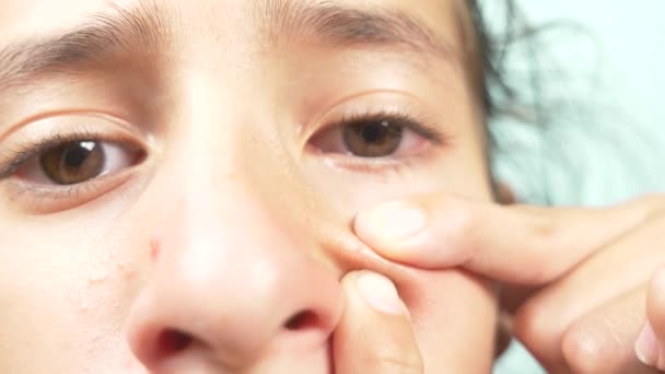 Ένα κορίτσι είναι συμπίεση μια ακμή στην μύτη της από τα δάχτυλά του ευρετηρίου. γκρο πλαν, 4k, αργή κίνηση — Αρχείο Βίντεο
