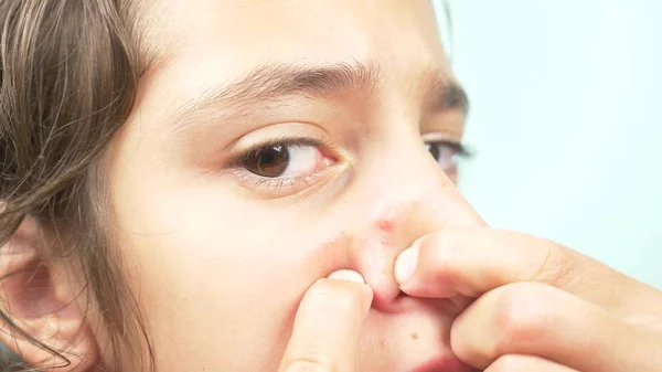 Dívka je mačkání akné na nose prsty její index. detail, — Stock fotografie