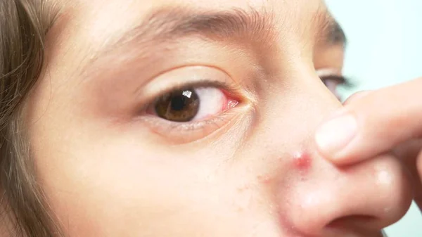一个女孩用食指挤压她鼻子上的粉刺。特写, — 图库照片