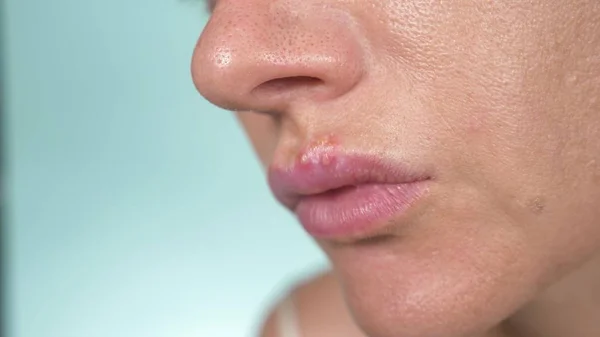 Herpès sur les lèvres féminines. gros plan, fond bleu, flou — Photo