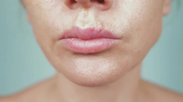 Herpes nos lábios femininos. close-up, fundo azul, borrão — Fotografia de Stock