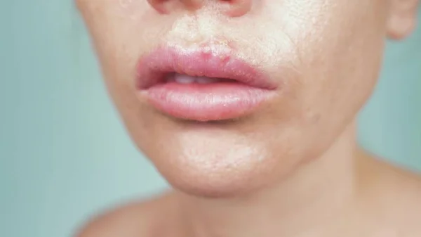 Herpes auf den weiblichen Lippen. Nahaufnahme, blauer Hintergrund, Unschärfe — Stockfoto
