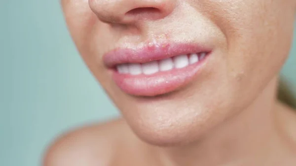 Herpes en los labios femeninos. primer plano, fondo azul, desenfoque —  Fotos de Stock