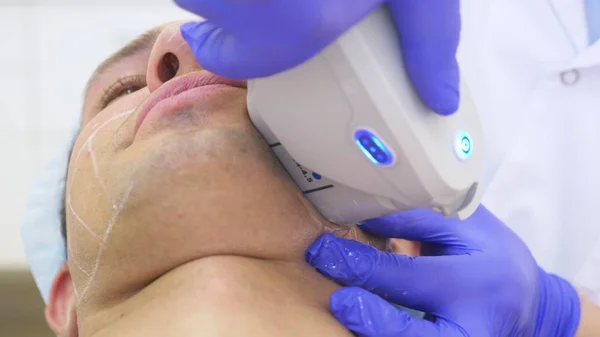 Πρόσωπο μη-χειρουργικά ανύψωσης. SMAS άρση υπερήχων. Η διαδικασία της αναζωογόνησης. Καλλυντικών υλικό. πλαστικό περιγράμματος προσώπου. τα χέρια του γιατρού δερματολόγου κάνουν έναν άνθρωπο ένα λίφτινγκ υπερήχων — Φωτογραφία Αρχείου