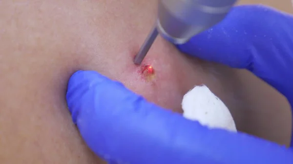 O médico dermatovenereologista queima uma marca de nascença na parte de trás de um homem com um feixe de laser. close-up . — Fotografia de Stock