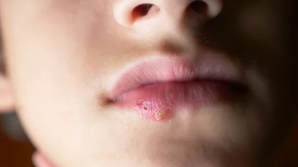 Герпес на губах хлопчика. герпес. лікування губ, простір для копіювання — стокове фото