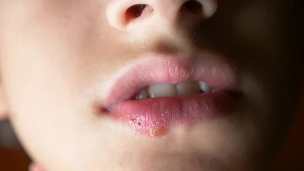 Herpes en los labios de un niño. herpes. tratamiento labial, espacio de copia — Foto de Stock