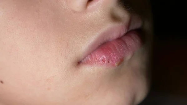 Herpes on the lips of a boy. herpes. lip treatment, copy space — Stock Photo, Image