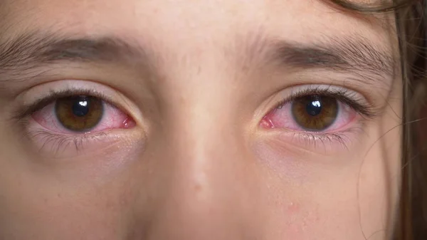 Close up. Little girl shows the eyes with conjunctivitis. The viral on eye. — Stock Photo, Image