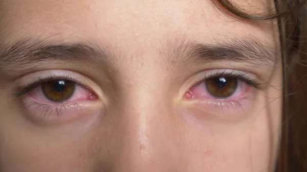 Ferme là. Petite fille montre les yeux avec conjonctivite. Le viral sur les yeux . — Photo