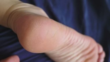 bacaklarda cilt sorunları kavramı. yakın çekim. kırık deri topuklar üzerinde