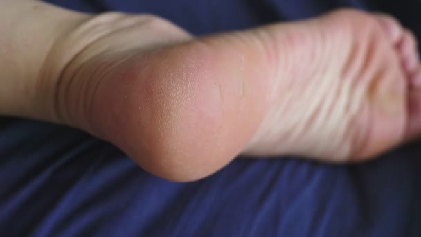 Koncept kožní problémy na nohou. detail. popraskané kůže na patách — Stock video