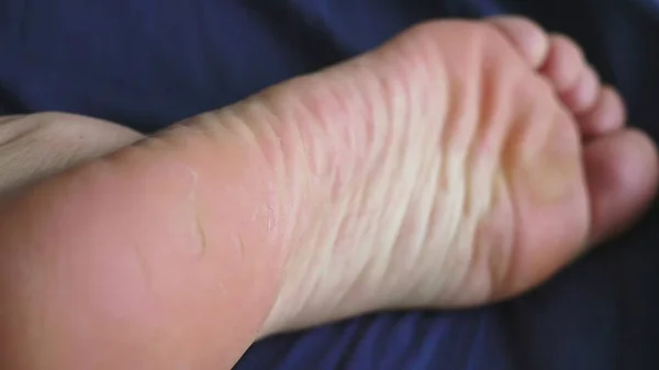 Concetto di problemi della pelle sulle gambe. primo piano. pelle incrinata sui talloni — Foto Stock