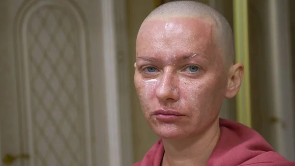 Bald exhausted woman on a blue background looks at the camera. she feels awkward due to her falling hair. concept of oncology and the effects of chemotherapy — Stock Photo, Image