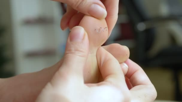 Splitter in de voet. close-up. een vrouwelijke hand zal een ijzeren veer uit een teen trekken. — Stockvideo