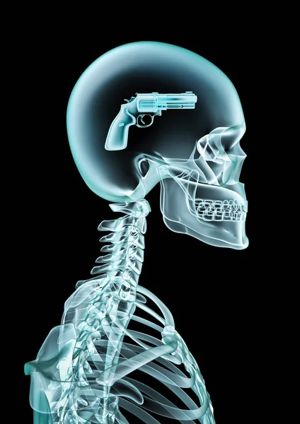 X射线犯罪头脑 人体骨架 射线的 插图显示头部内的手枪 — 图库照片