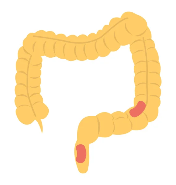 Inflamação Intestino Grosso Que Descreve Cancro Intestino — Vetor de Stock