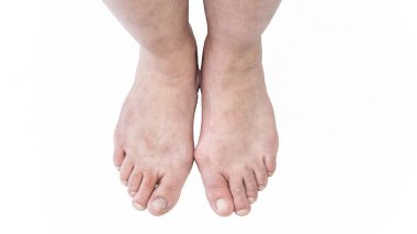 hallux valgus ayak fotoğraf tıp