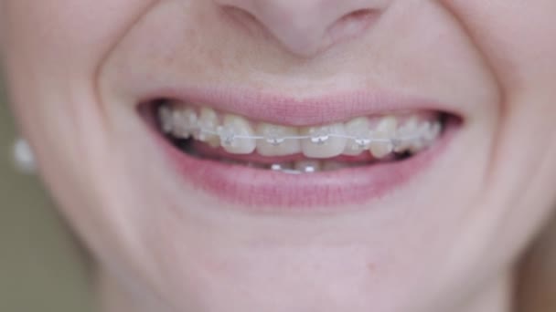Fogszabályzót a fogakra. A lány mosolyog, fogszabályzót mutat a fogán.. — Stock videók