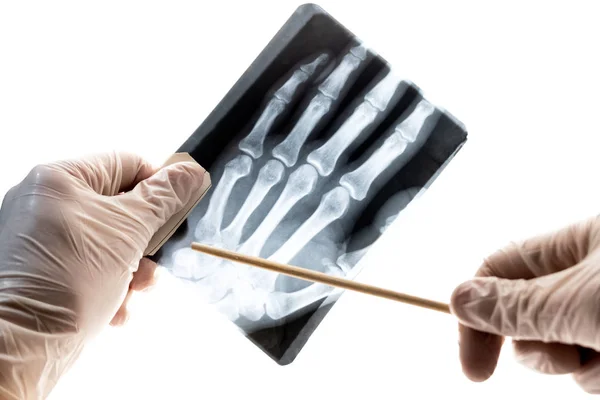 Csont Ujját Vagy Ízületek Elmozdulása Kár Fogalmára Egy Orvos Fehér — Stock Fotó