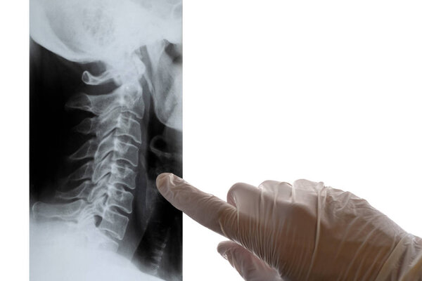 A doctor in white gloves points a finger at an x-ray of the cervical spine. Close-up. Copy space. Isolate. Concept on a medical theme, day of radiologist.