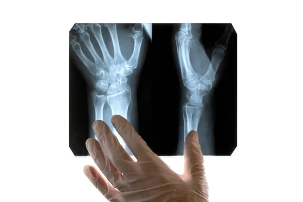 Fehér Kesztyű Orvos Megvizsgálja Sérült Kezét Röntgen Közelről Orvosi Téma — Stock Fotó