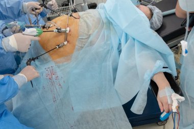Endoskopi. Tam bir kadın cesedi ameliyat. Endovideosurgery. Cerrahlar eller Endo-enstrümanlar kullanarak hastanın karın hastanede cerrahi bir tablo üzerinde ameliyat.