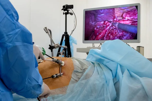 A team of surgeons using endo-instruments operate the patient\'s abdomen. Endoscopy. Surgery on the body of a complete woman is broadcast online on a monitor or high-definition television. Operating room in the hospital. Surgical table. Endovideosurge