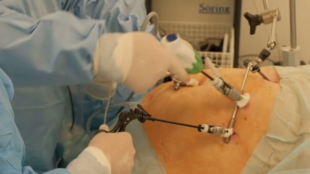 Moderna framsteg i medicin. Endoskopi. Läkare använder endo-instrument och videokameror för att operera i bukhålan av en fet kvinna. Endovideosurgery. Laparoskopi. — Stockvideo