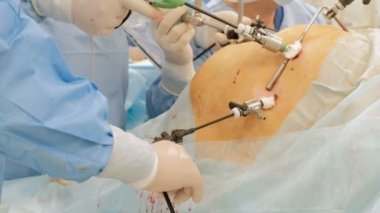 Laparoskopi. Endo-cihazlar ve video kameralar kullanarak doktorlar elinde şişman bir adam ya da hamile bir kadın karın boşluğuna ameliyatı. Modern gelişmeler tıpta. Endoskopi. Endovideo.