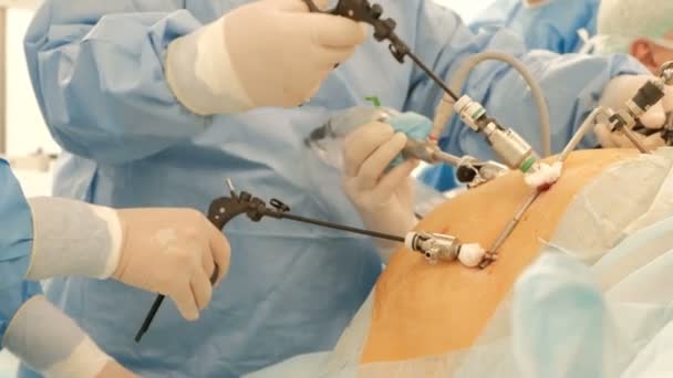 Laparoscopie. Gros plan. Chirurgiens mains à l'aide de matériel endoscopique et instruments effectuer la chirurgie d'un gros homme ou une femme enceinte. Endoscopie. Une équipe de médecins au travail. Endovidéochirurgie . — Video