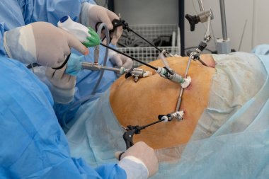 Laparoskopi. Laparoskopik aletler kullanarak doktorlar elinde şişman bir adam ya da hamile bir kadın karın boşluğuna ameliyatı. Endoskopi. Modern gelişmeler tıpta. Endovideosurgery.