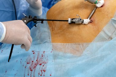 Endoskopik cerrahi laparoskopi. Bir cerrah bir tam veya hamile kadın çalışır. Yakın çekim. Uzay kopyalayın. Hastanede ameliyathane. Tıp modern gelişmeler.