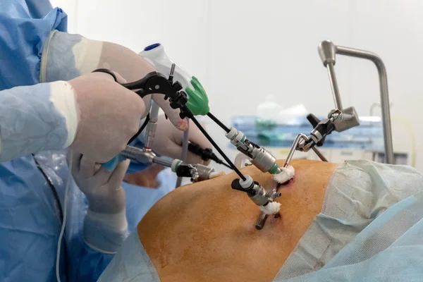 Doktorlar endo-cihazlar ve video kameralar cerrahi şişman bir kadın karın boşluğunda yapmak için kullanın. Endoskopi. Modern gelişmeler tıpta. Hastanenin ameliyathane yordamda