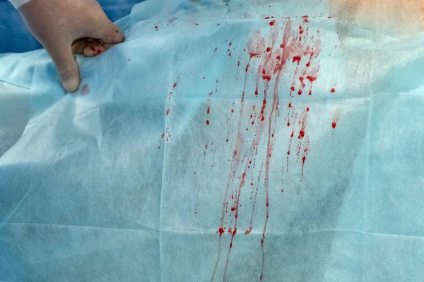 流血を削除し 病院の手術室の汚れ 白い手袋で外科医の手 領域をコピーします 青の医学的背景 — ストック写真