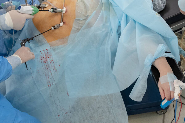 Endovideosurgery. The hands of surgeons with tools and the body of the female on the surgical table. Endoscopy. Surgery on the abdomen of a fat woman.