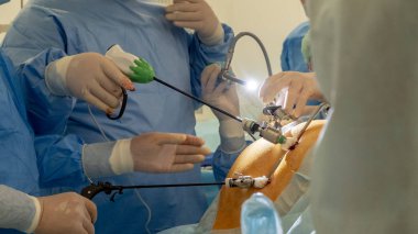 Endoskopi, laparoskopi, ameliyat. Cerrahlar bir takım tıbbi endo-video malzeme ve aletleri kullanarak bir işlemi gerçekleştirir. Karın, yerel delikler aydınlatma. Bir hastanede ameliyat odasında.