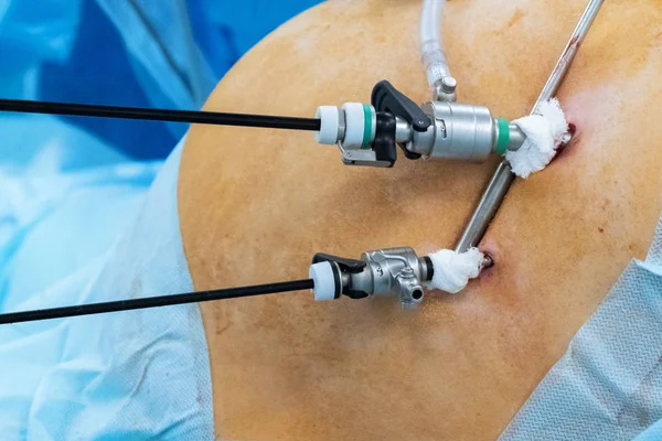 Endoscopy, laparoscopy, surgery.Treatment of hernia, gynecological or gastrological problems.Operating room in a hospital.Close-up of the patient's large abdomen with holes for endovideosurgery tools.