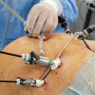 Cerrahi aletler endo video giriş hastanın karın boşluğu içine. Endoskopi. Laparoskopi. Kare kare. Ameliyathane Cerrahi Hastanesi.