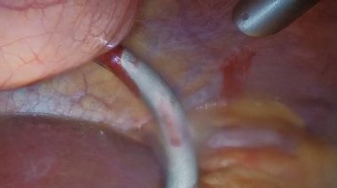 Endoskopi. Cerrahi yayın bir monitör veya Tv ekranında. İnsan karın boşluğu iç organların. Laparoskopik bir video kameradan görüntülemek.