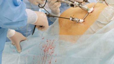 Endosurgery. Bir takım cerrah yağ veya hamile bir kadının karın üzerinde bir işlem gerçekleştirir. Hastanede ameliyathane. Laparoskopik. Doktorlar elinde Endovideosurgical aletleri.