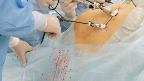 Endosurgery Bir Takım Cerrah Yağ Veya Hamile Bir Kadının Karın — Stok video