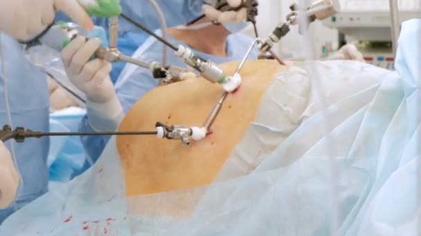 Laparoscopia. Operazione endovideo-chirurgica. Primo piano. Un team di chirurghi esegue l'endoscopia per una donna incinta o grassa. Il concetto di medicina moderna. Movimento della fotocamera — Video Stock