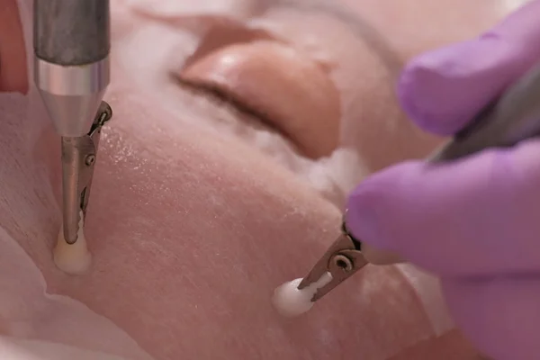 Microcurrent gladmaken van rimpels. Close-up. Een professionele cosmetoloog in Lila Handschoenen werkt met twee elektroden door een masker op de vrouwelijke Wang. Cosmetische verjongende procedure. Tillen van de huid — Stockfoto