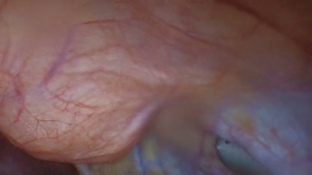 Endovideosurgery. Laparoskopie. Zobrazení videokamery v břišní dutině nemocné pacientky. — Stock video