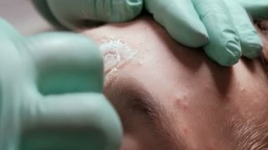 Şekerleme. Eldivenli bir güzellik uzmanı, kaşların arasındaki gencin yüzündeki kıllarla birlikte bir parça şeker macunu koparıyor. Epilasyon. Kozmetoloji prosedürü. Close.