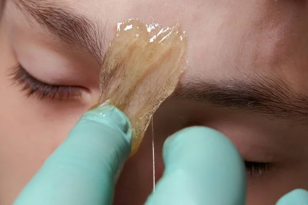 Een schoonheidsspecialiste met handschoenen zet een stukje suikerpasta op de neusbrug met haartjes tussen de wenkbrauwen. Cosmetologie procedure. Close-up van een deel van het gezicht van een tiener kerel. Chaptalisatie. Epileren. — Stockfoto