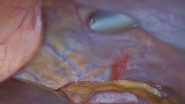 Endoscopie Chirurgie Diffusion Sur Moniteur Écran Télévision Les Organes Internes — Video